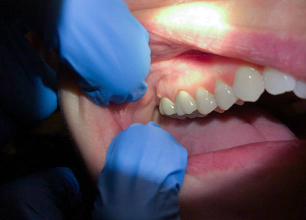 Best Chipped Tooth Repair Near Me  in East Palatka, FL